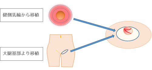 健側乳輪から移植・大腿期部より移植